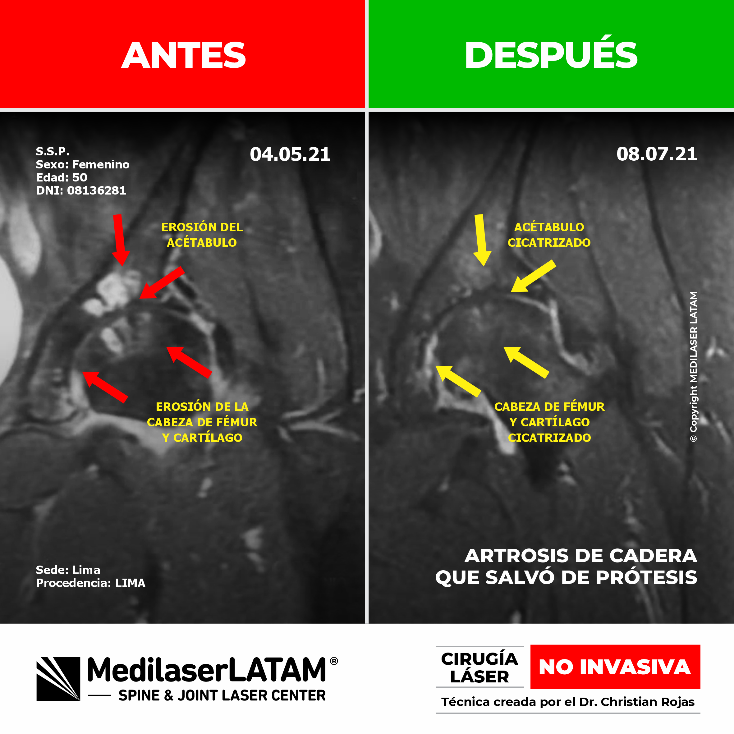 Caso radiológico de artrosis de rodilla severa con evolución favorable. Alternativa eficaz y NO INVASIVA para evitar el implante de prótesis.