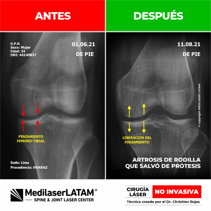 Radiografía de antes y después en desgaste severo de rodilla. Tratamiento médico láser que demostró evitar de forma efectiva la prótesis.