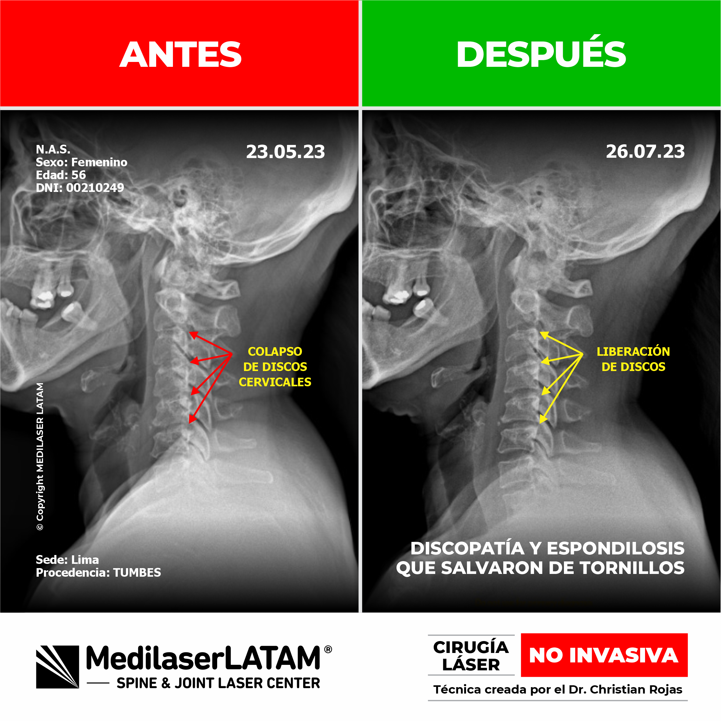 Evidencia científica de la regresión en artrosis cervical. Resultados clínicos comprobados con el tratamiento de Cirugía Láser NO INVASIVA.