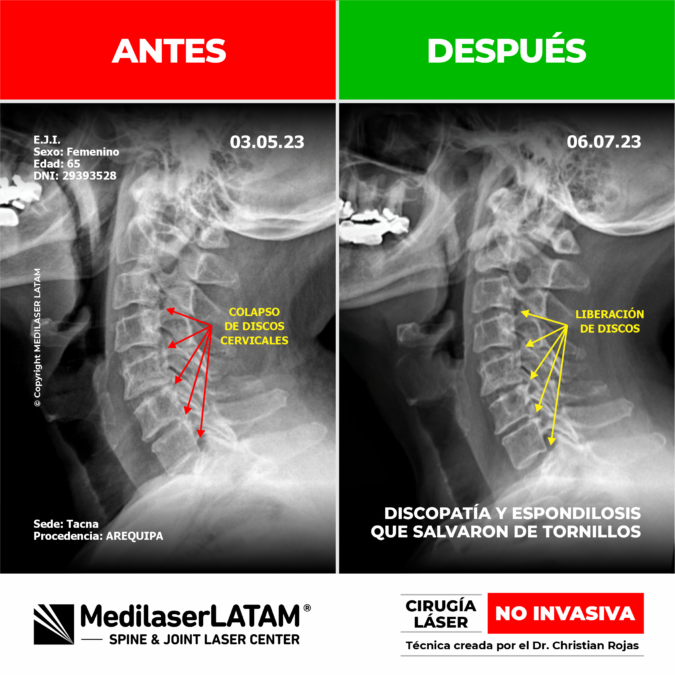 Documentación médica sobre la regresión en artrosis cervical. Alivio del dolor y recuperación articular con tecnología láser NO INVASIVA.