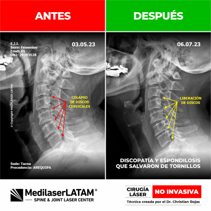 Documentación médica sobre la regresión en artrosis cervical. Alivio del dolor y recuperación articular con tecnología láser NO INVASIVA.