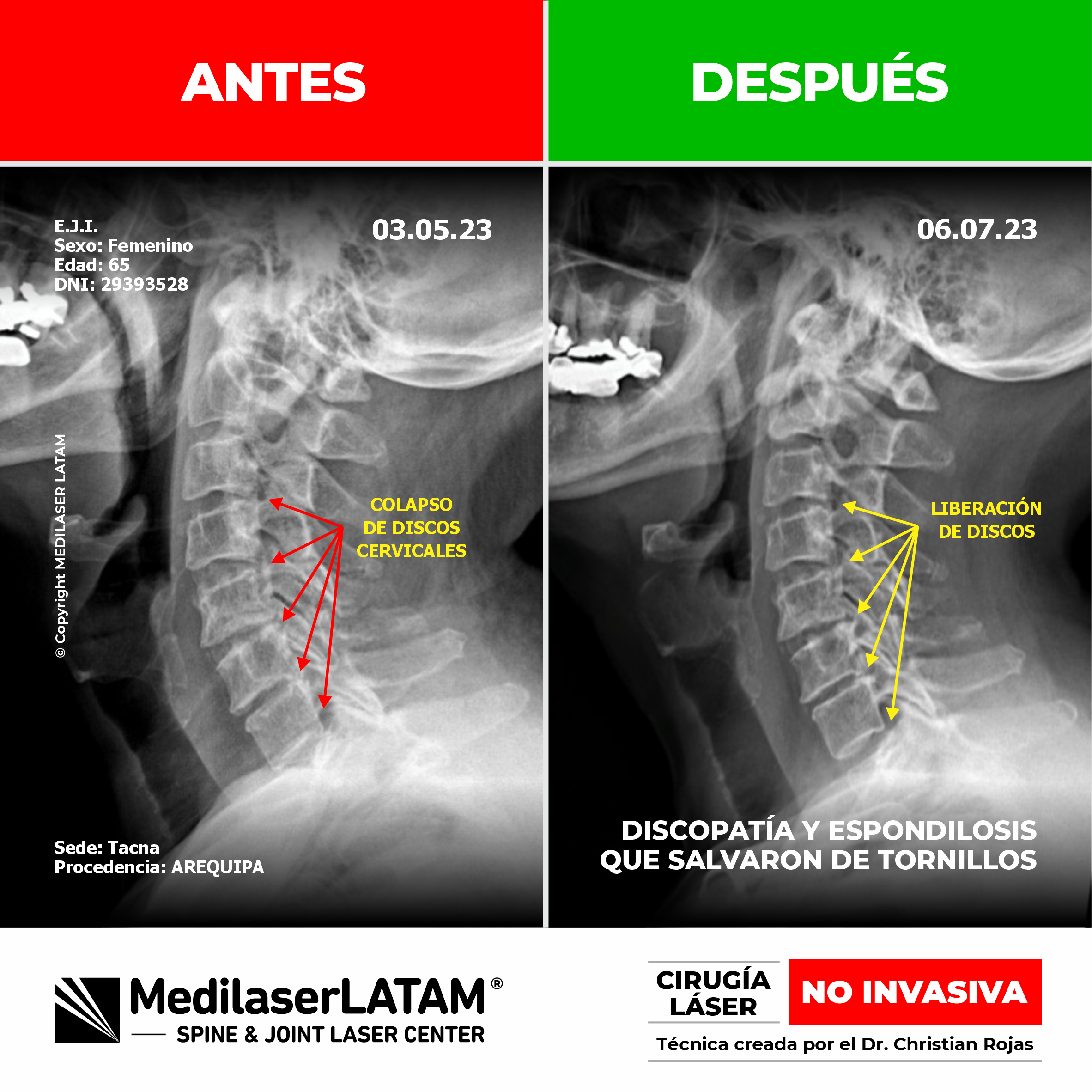 Documentación médica sobre la regresión en artrosis cervical. Alivio del dolor y recuperación articular con tecnología láser NO INVASIVA.