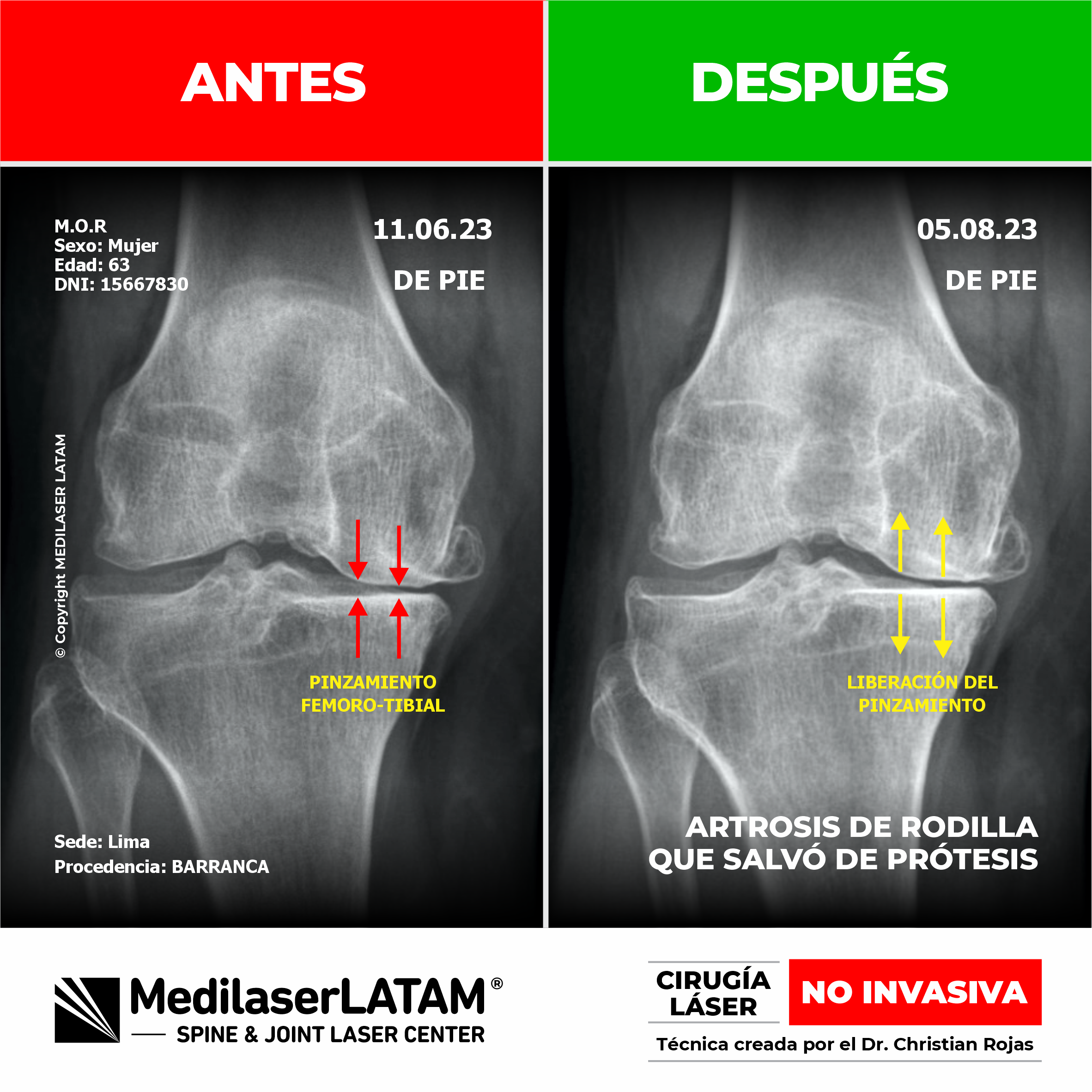 Estudio radiológico que demuestra la regresión en gonartrosis. Recuperación de la articulación de la rodilla con Cirugía Láser NO INVASIVA.