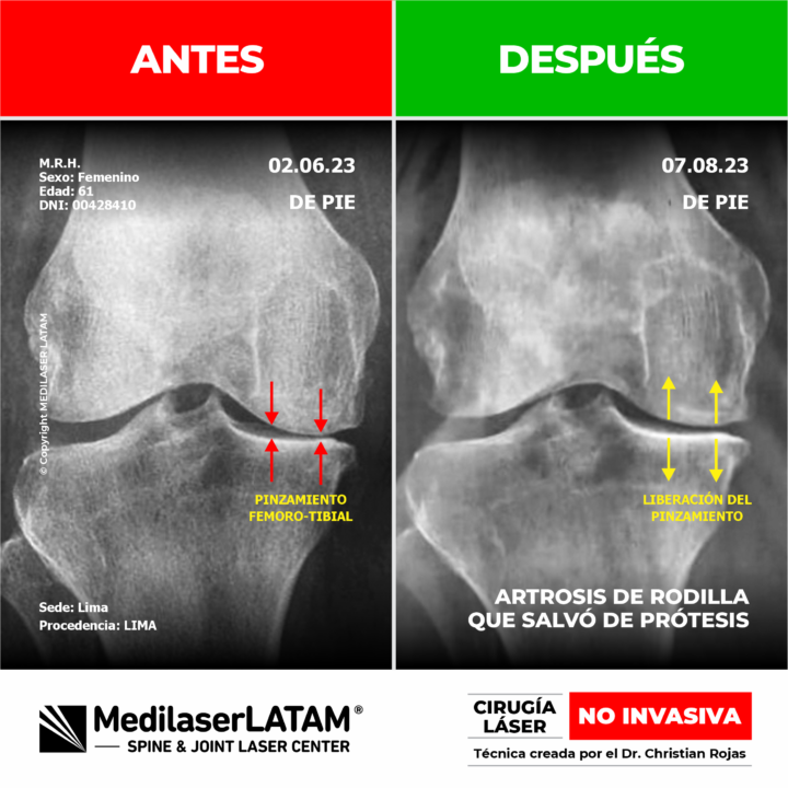 Casos clínicos de éxito que demuestran la regresión en artrosis mediante la aplicación de Cirugía Láser de columna y articulaciones.