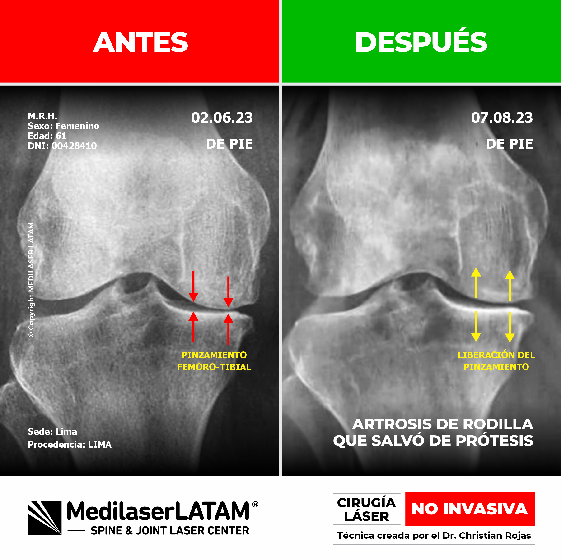 Casos clínicos de éxito que demuestran la regresión en artrosis mediante la aplicación de Cirugía Láser de columna y articulaciones.