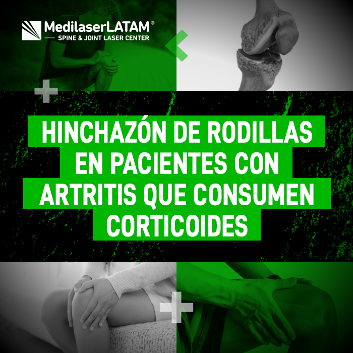 Descubre la relación entre el uso de corticoides y la persistencia de la inflamación articular en personas con diagnóstico de artritis.