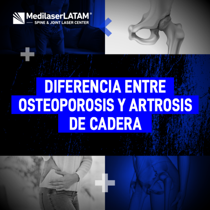 Aprende a distinguir entre el desgaste del cartílago articular y la pérdida de densidad ósea para buscar el tratamiento correcto.
