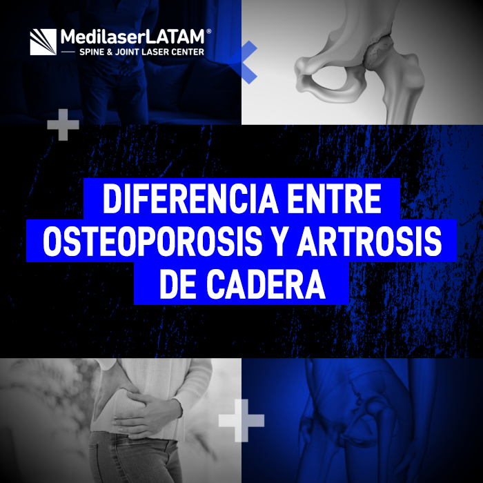 Aprende a distinguir entre el desgaste del cartílago articular y la pérdida de densidad ósea para buscar el tratamiento correcto.