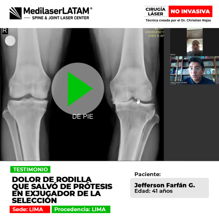 Descubre cómo la tecnología médica avanzada ayudó a un reconocido exfutbolista profesional a evitar una cirugía de prótesis.
