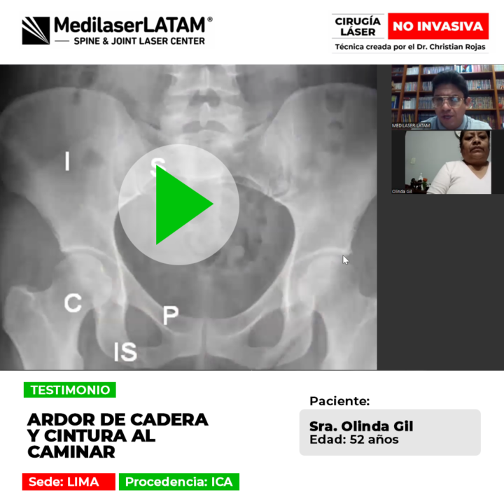 ¿Sientes quemazón constante al dar unos pasos? Conoce el testimonio de una paciente que alivió el ardor en cadera y zona lumbar.