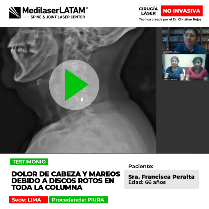 Infórmate sobre cómo las hernias de disco severas causan migrañas y mareos, y la solución médica que ayudó a la paciente.