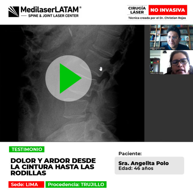 Descubre la historia de la paciente que logró aliviar la intensa quemazón y rigidez que se extendía por todas sus piernas.