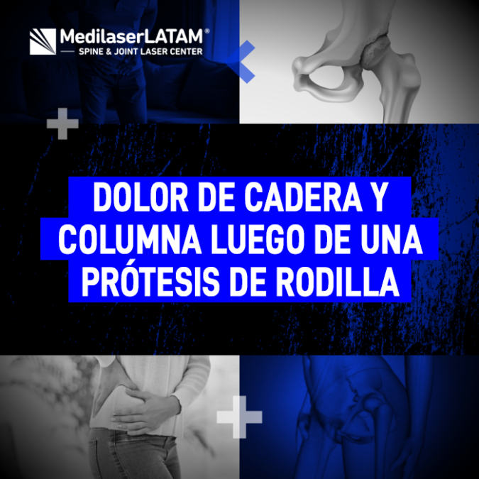 Entiende por qué puede aparecer un fuerte dolor de cadera o malestar lumbar tras someterte a una cirugía de reemplazo articular.
