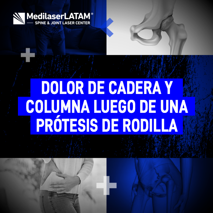Entiende por qué puede aparecer un fuerte dolor de cadera o malestar lumbar tras someterte a una cirugía de reemplazo articular.