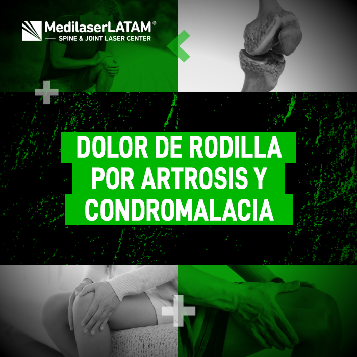 El dolor de rodilla por artrosis y condromalacia rotuliana afecta tu movilidad diaria. Descubre el origen exacto de este malestar.