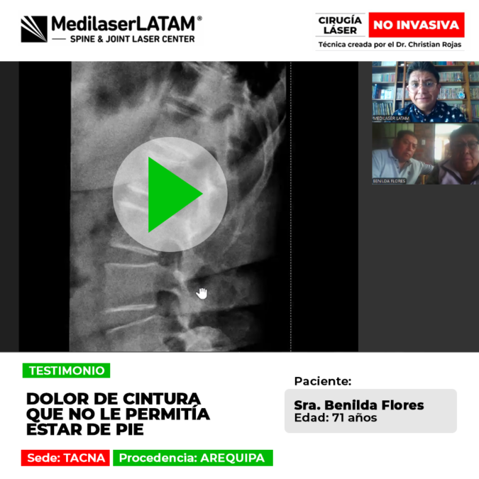 ¿Sufres de un dolor de cintura incapacitante? Descubre el tratamiento médico que ayudó a una paciente a recuperar su movilidad y bienestar.