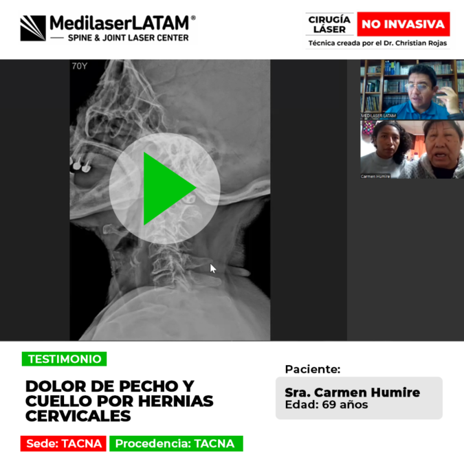 Conoce la historia de la paciente que lidiaba con un incapacitante hernias cervicales que afectaba su pecho y cuello, y descubre cómo se recuperó.