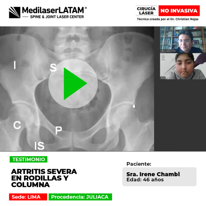 Sorpréndete con el testimonio de superación de una paciente que sufría de artritis severa en sus articulaciones y encontró una solución para su dolor.