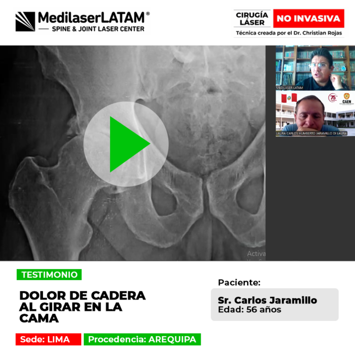 El dolor de cadera al girar en la cama atormentaba a este paciente de Arequipa. Descubre el tratamiento que devolvió su descanso.