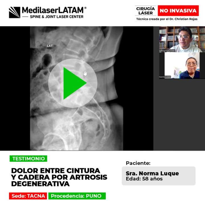 La artrosis degenerativa causaba un fuerte dolor entre la cintura y cadera a esta paciente de Puno. Conoce su historia de recuperación.