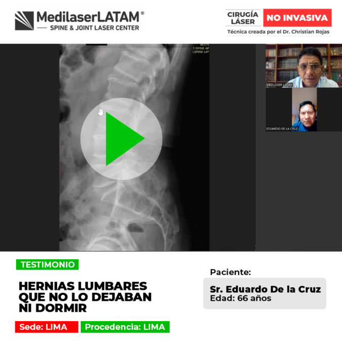 Las hernias lumbares agudas causan intensos dolores que impiden conciliar el sueño. Conoce procedimientos médicos para el alivio.