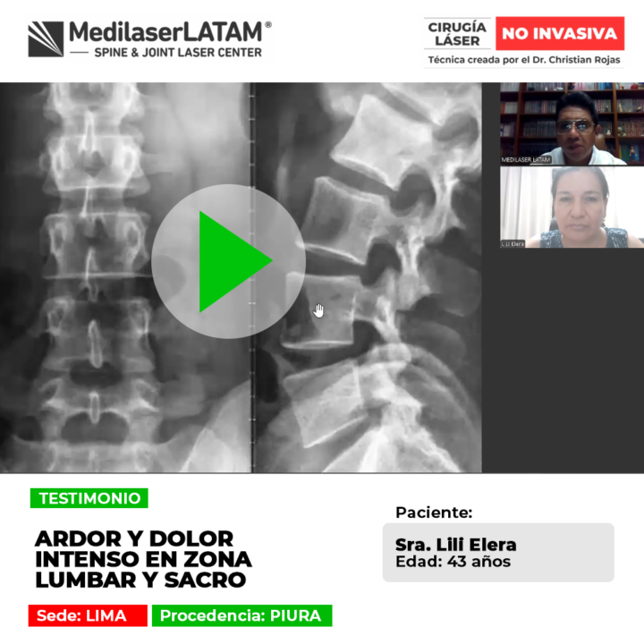 El dolor en zona lumbar y sacro suele vincularse a compromiso nervioso. Infórmate sobre tratamientos oportunos para su control.