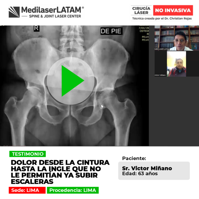 El dolor de cintura irradiado hacia la ingle limita el movimiento cotidiano. Conoce tratamientos especializados para subir escaleras sin dolor.