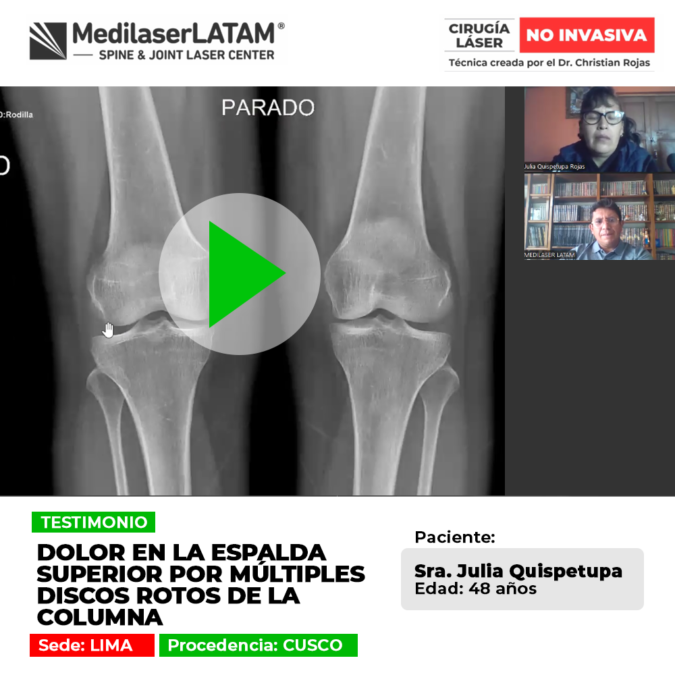 Los discos rotos columna causan intensas molestias en la espalda superior. Infórmate sobre alternativas médicas para aliviar los síntomas.